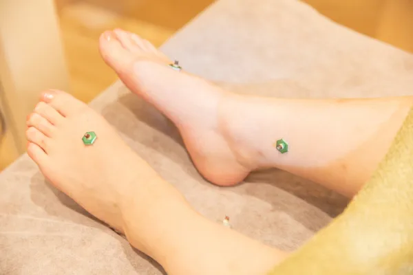 cuna鍼灸整骨院でのお灸の様子